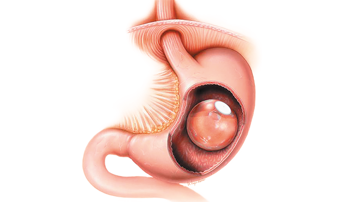 Intragastric balloons procedure